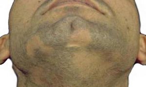 Алопеция мужской бороды: симптомы, причины, как лечить